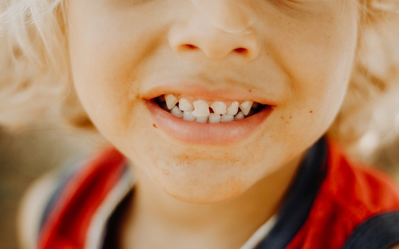 Baby Bottle Tooth Decay