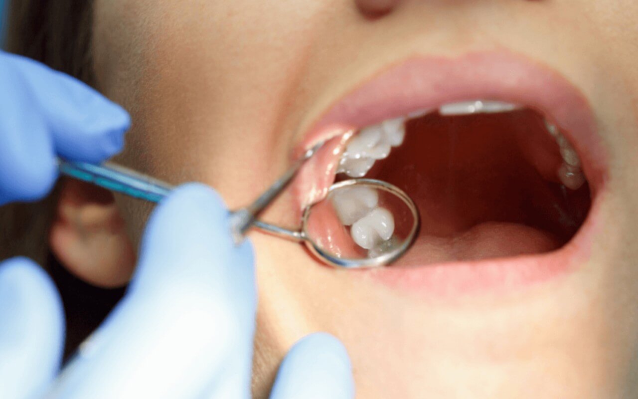 Dental Sealants