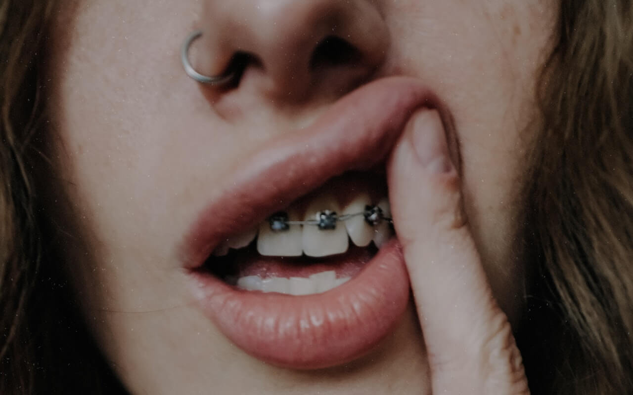 Braces Painful