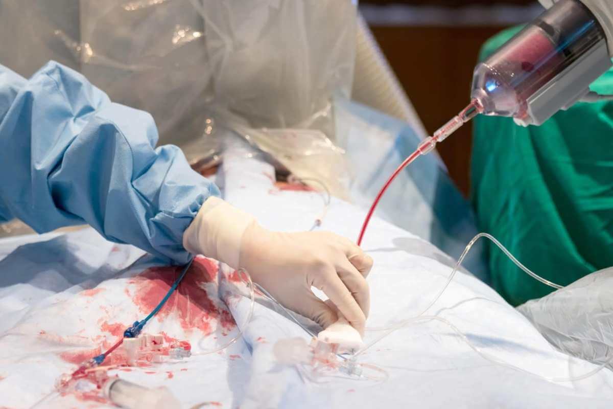 ROTA-PRO Angioplasty